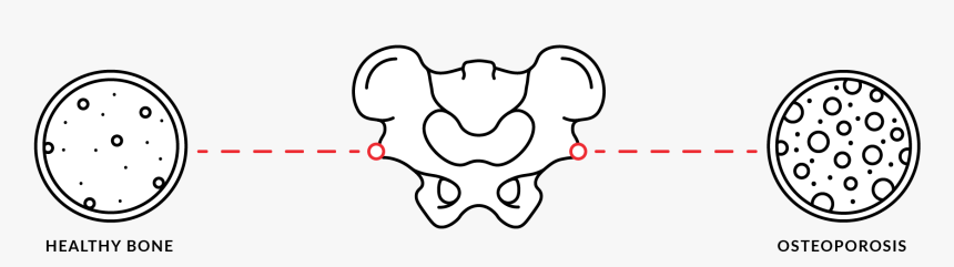 Osteoporosis Clipart, HD Png Download