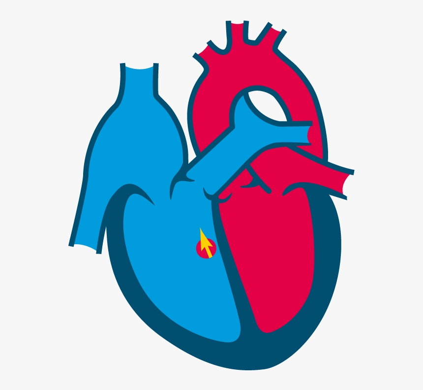 Perimembranous Vsd - Congenital Heart Disease Clipart, HD Png Download