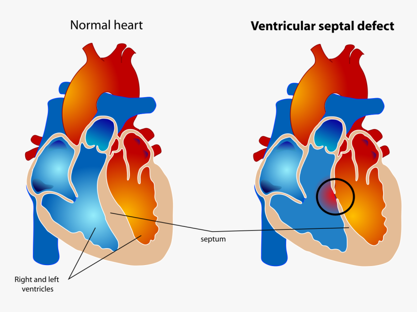 Small Ventricular Septal Defect, HD Png Download
