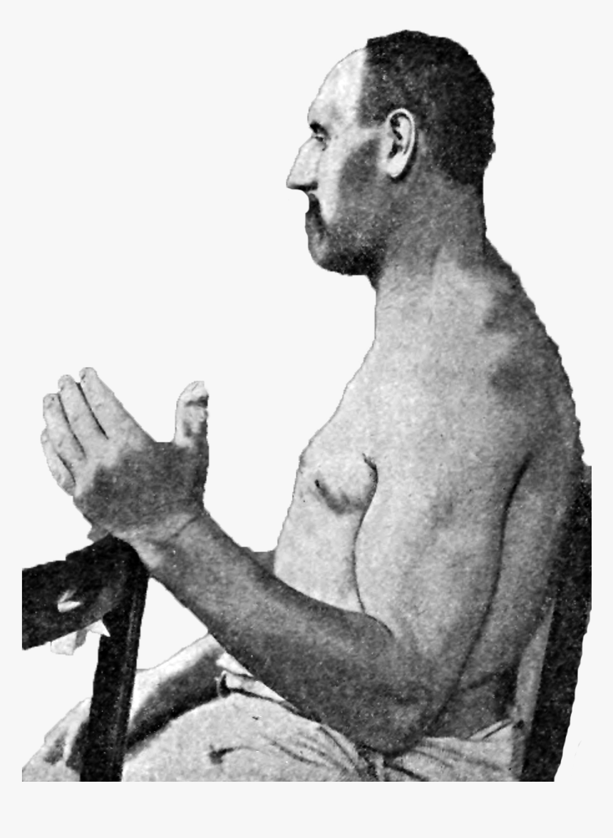 Athletic Type & Acromegaly - Acromegaly Png, Transparent Png