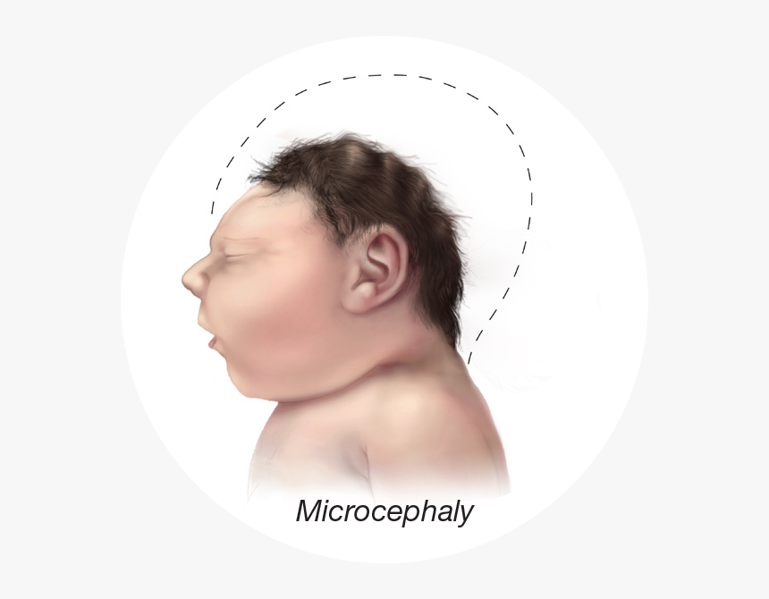 Baby Small Head - Zika Baby, HD Png Download