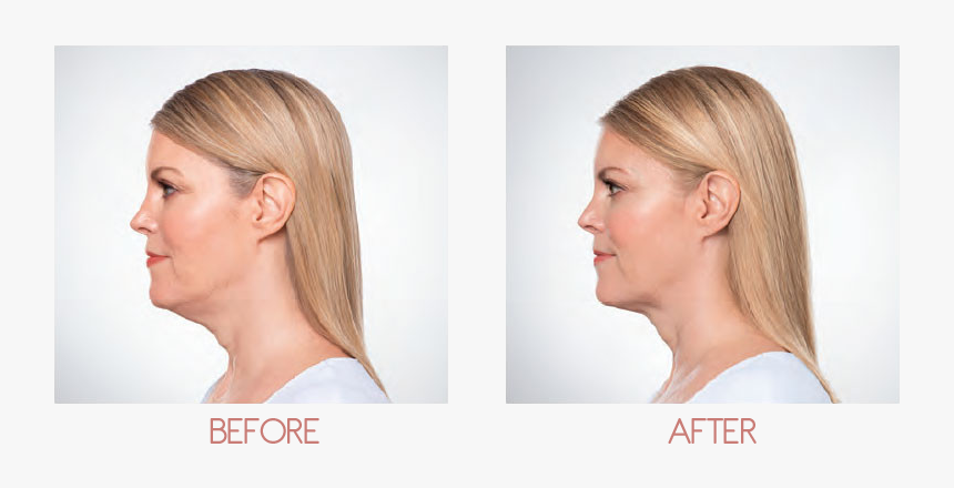 Chin Fat Removal, HD Png Download