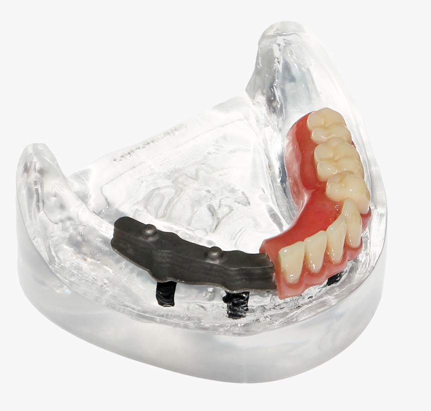 Supra Solution Bar Denture Photo - Tongue, HD Png Download