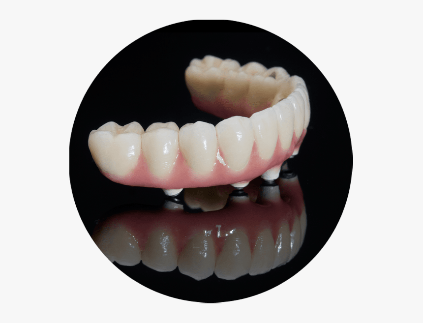 Implant Supported Bridge - Full Arch Dental Implants, HD Png Download