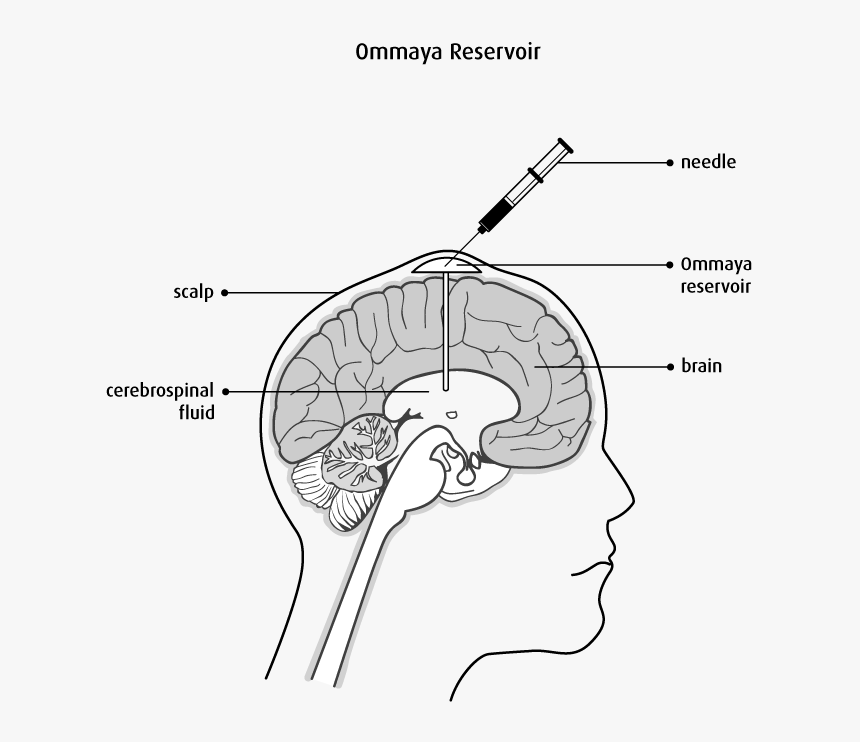 Chemotherapy For Brain Tumor, HD Png Download