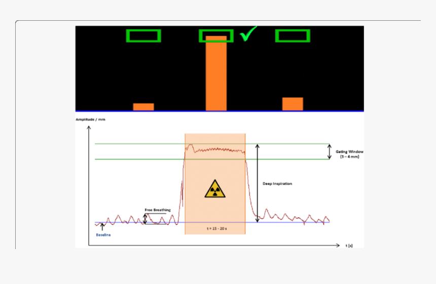 Deep Inspiration Breath Hold Gated Radiotherapy, HD Png Download