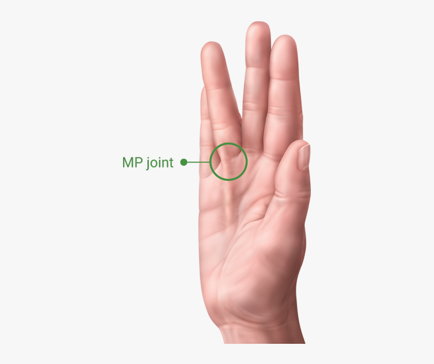 A Hand With Dupuytren’s Contracture Showing The Pip - Facts On Hand Dupuytren's Contracture, HD Png Download