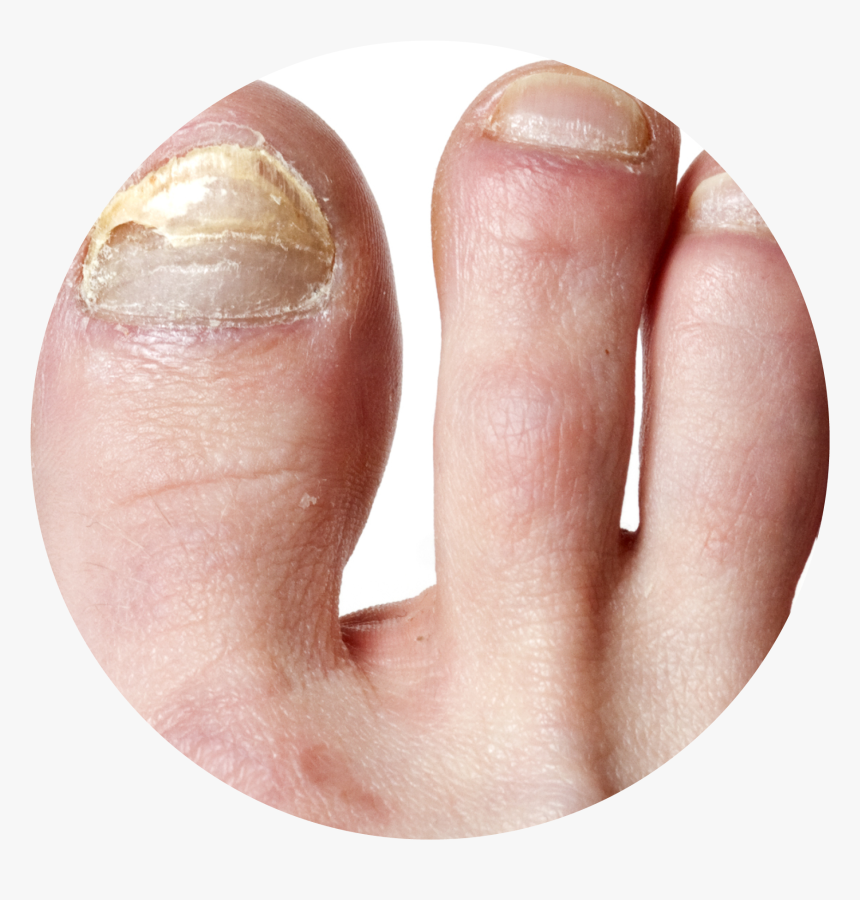 Nail Infection Circle - Грибок На Ногтях Ног, HD Png Download