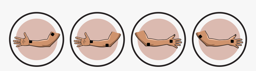 Ulnar Nerve Lesion Electrode Pad Placement Clipart, HD Png Download