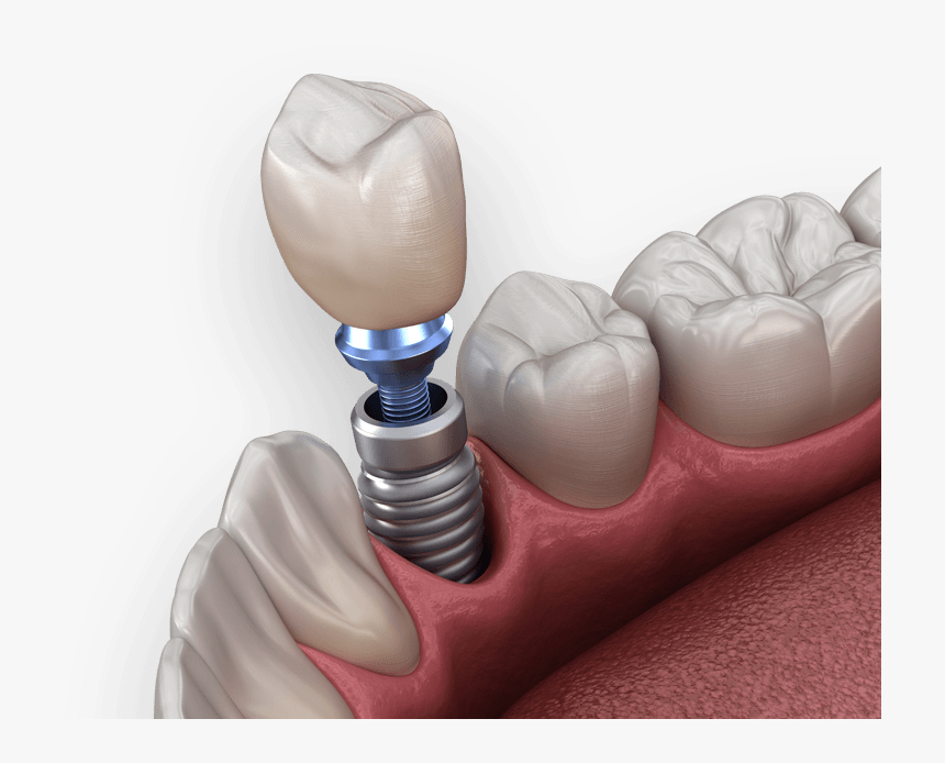 Dental Implants - Implant Dental Png, Transparent Png