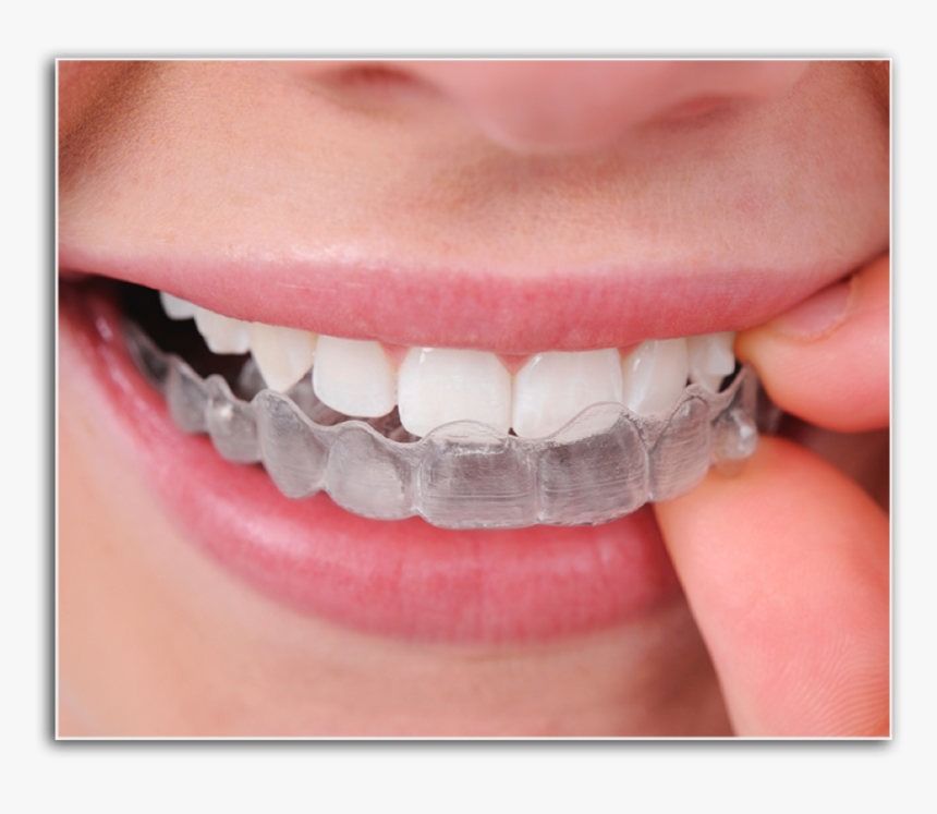 Closeup Of Patient Placing Invisalign Tray - Invisalign Braces Cost In India, HD Png Download