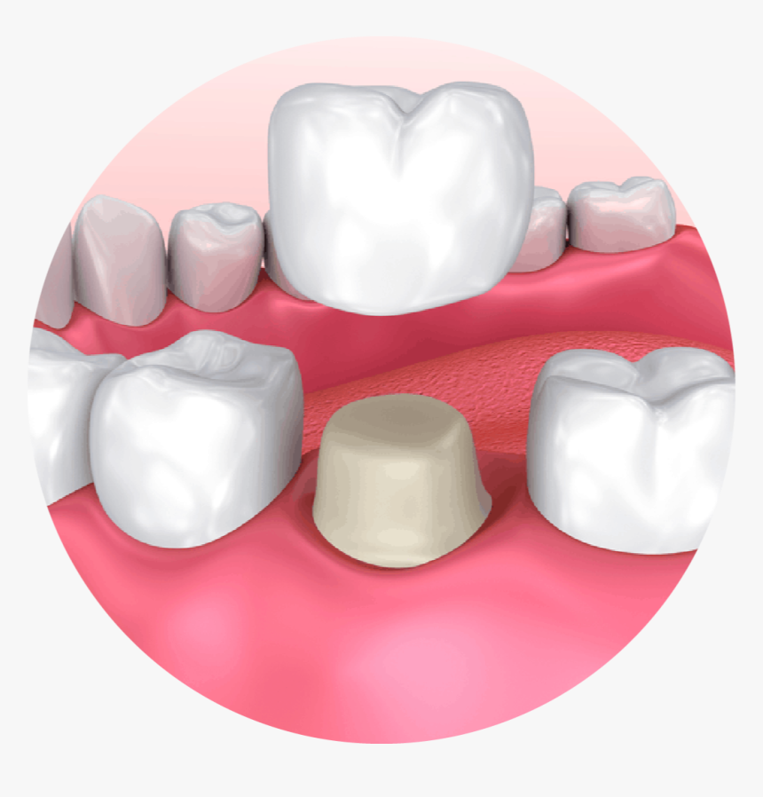 What Is A Dental Crown - Dental Crown, HD Png Download