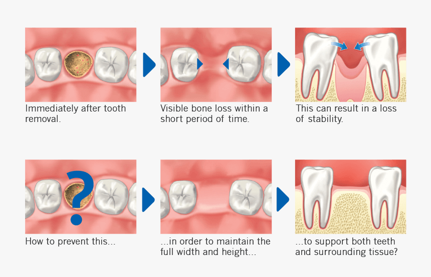 The Bone Surrounding Images - Socket Preservation Graft, HD Png Download
