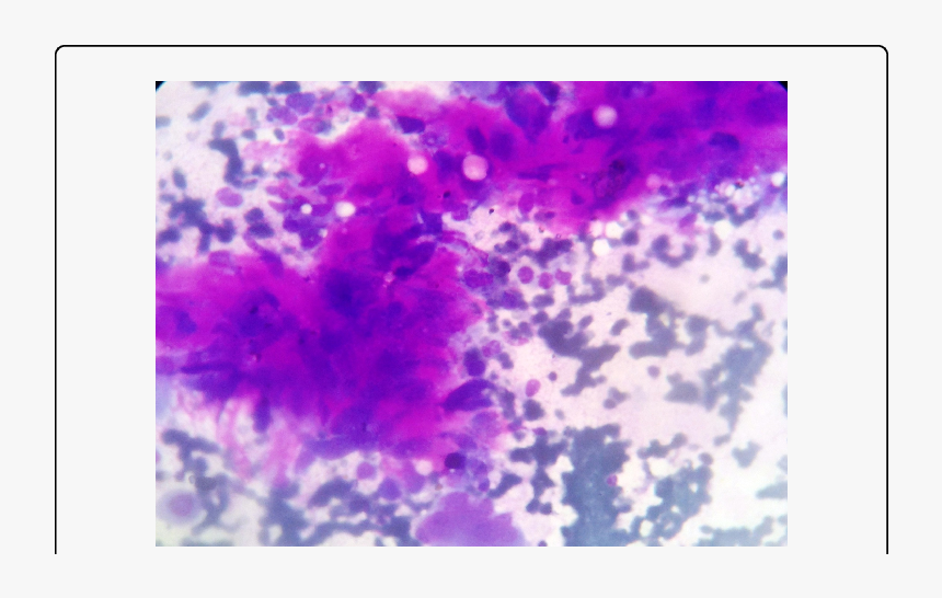 Clusters Consisting Of Tumor Cells With Spindle Cell - Visual Arts, HD Png Download