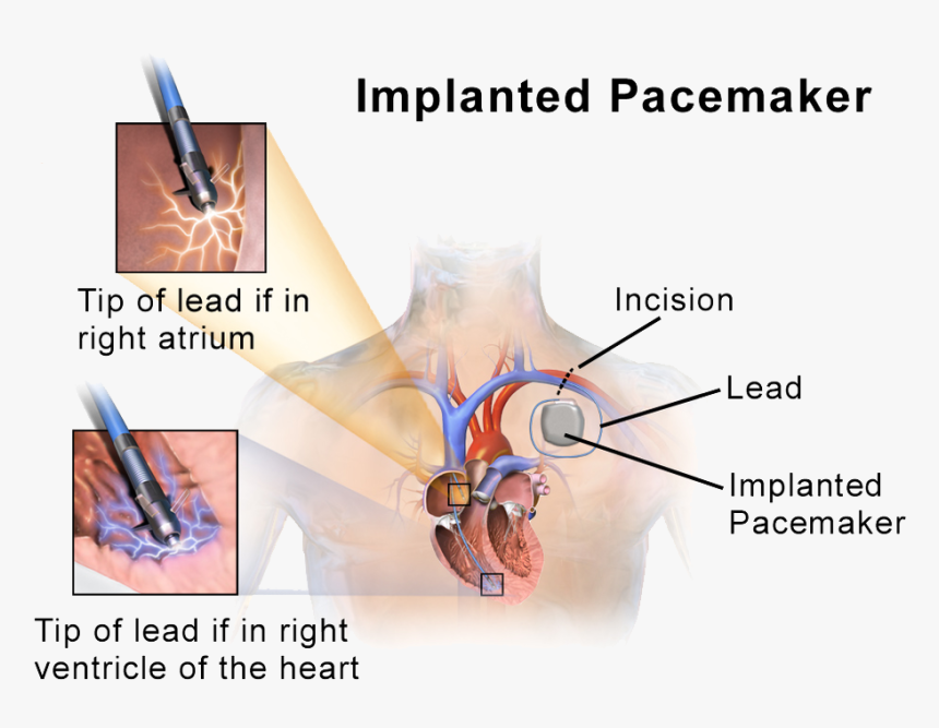 Implantable Cardioverter Defibrillators, HD Png Download