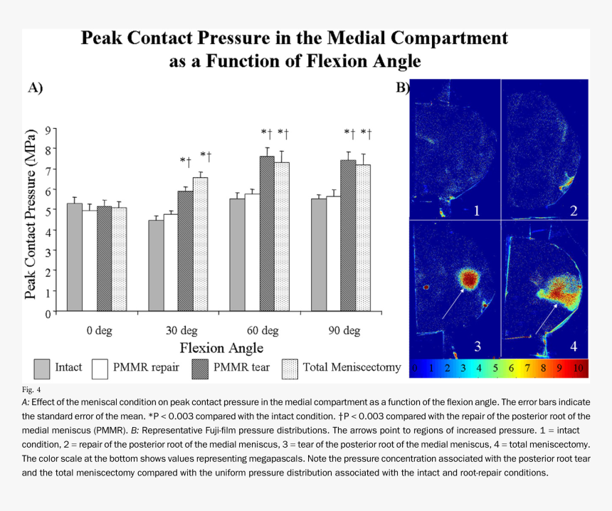 Effect Of The Meniscal Condition - Pressure On Meniscus, HD Png Download