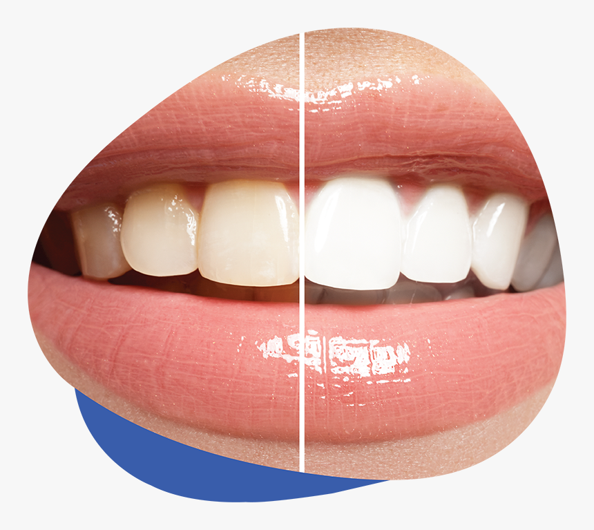 Teeth Whitening - Ranking Past Do Zębów Wybielających, HD Png Download