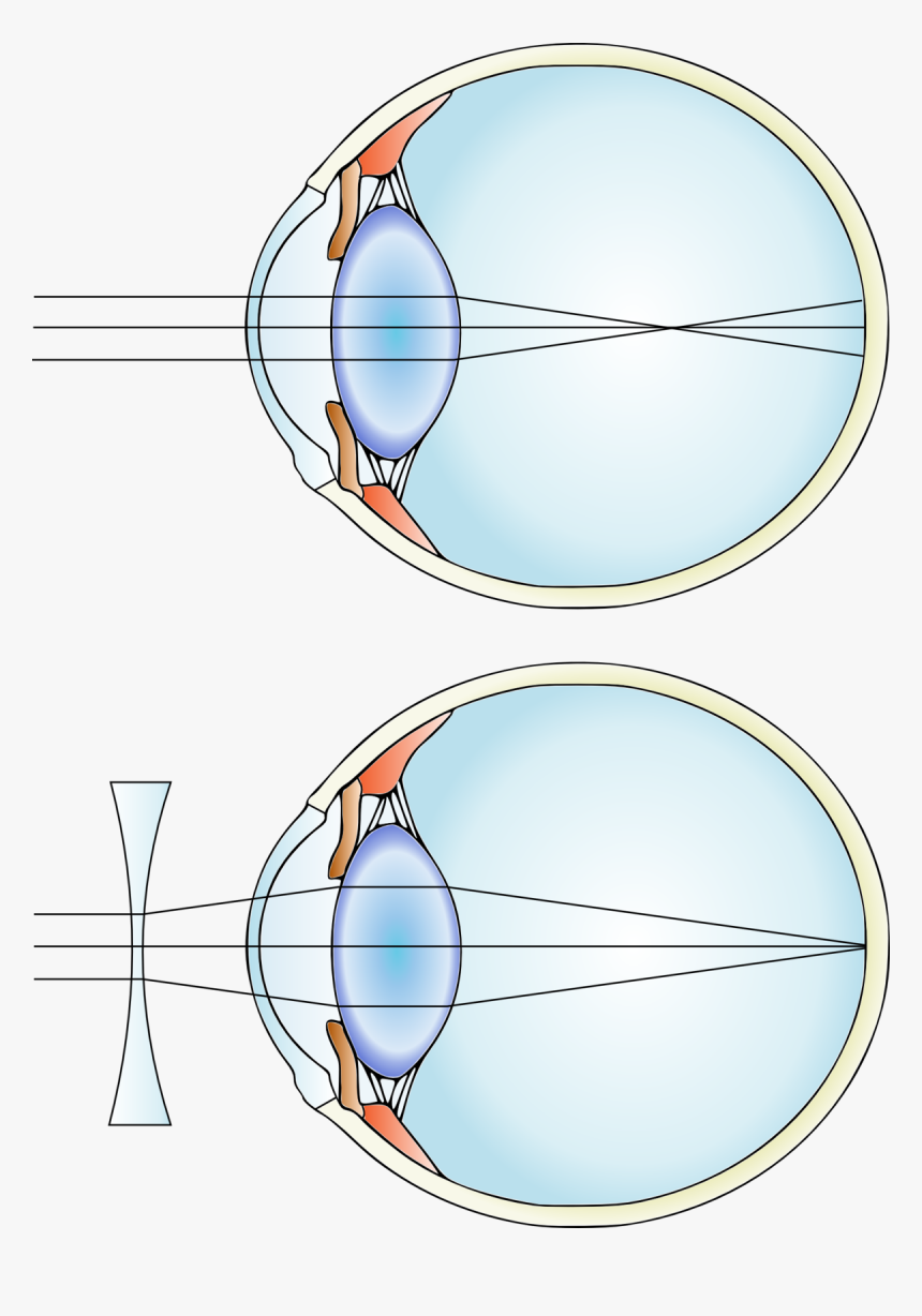 Myopia Mcat, HD Png Download