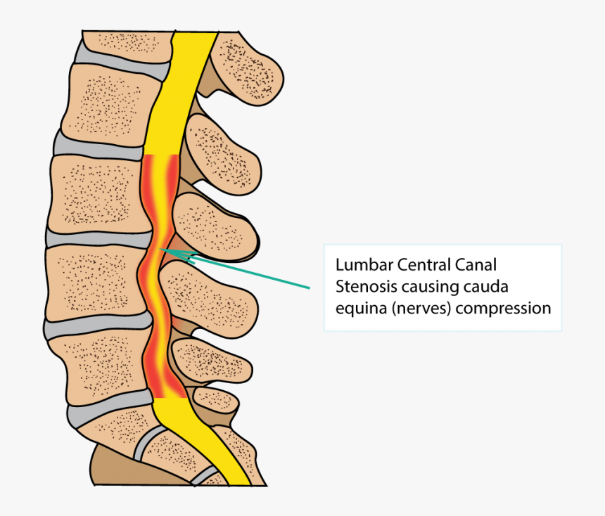 Spinal Stenosis, HD Png Download