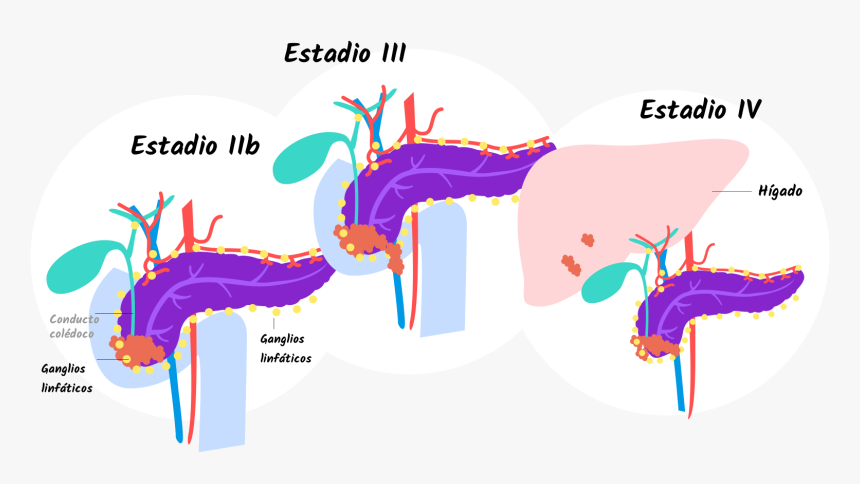 Pancreatic Cancer Stage 4 Tumor, HD Png Download