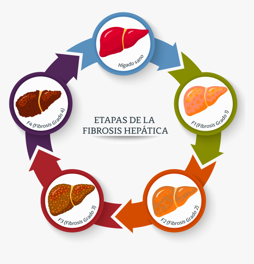 Guía De Interpretación De Fibrosis Hepática - Theory Of Constraints, HD Png Download