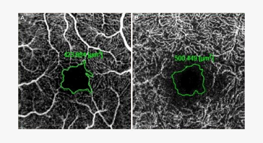 Oct Angiography Foveal Avascular Zone, HD Png Download