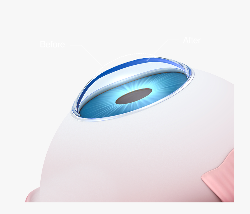 Illustration Of Before And After Lasik - Circle, HD Png Download