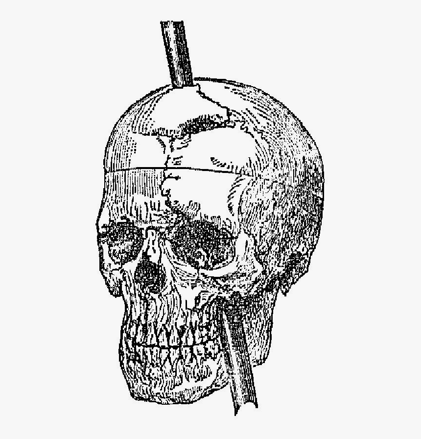 Recovery From The Passage Of An Iron Bar Through The - Phineas Gage Skull, HD Png Download