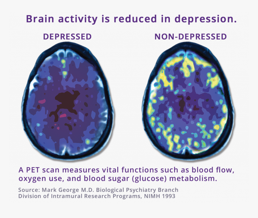 Pet Scan Comparing Depressed Brain To Non-depressed - Tms Depression, HD Png Download