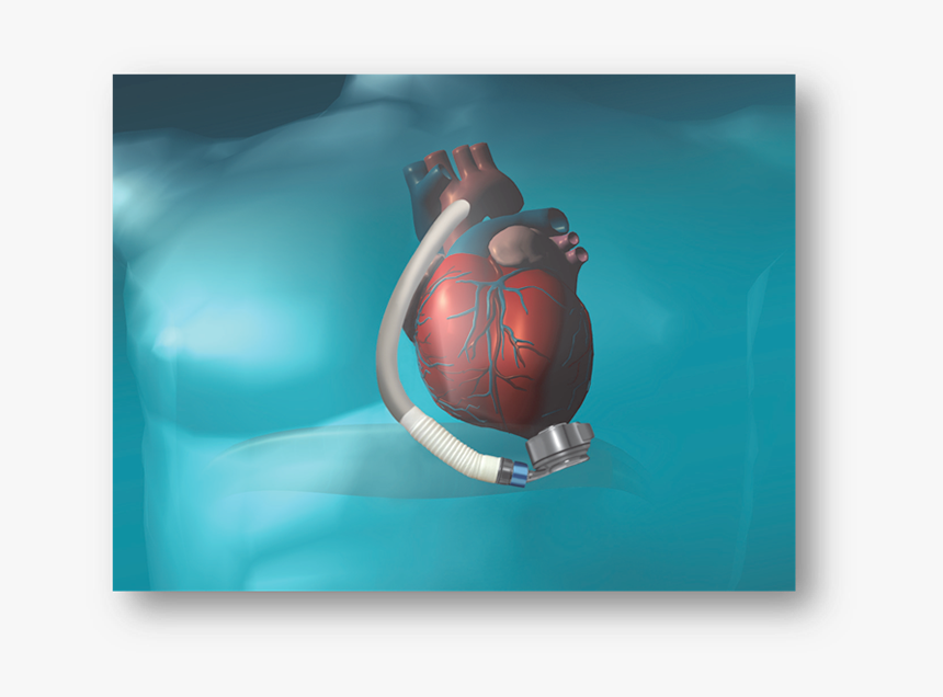 Heartmate 3 Abbott, HD Png Download