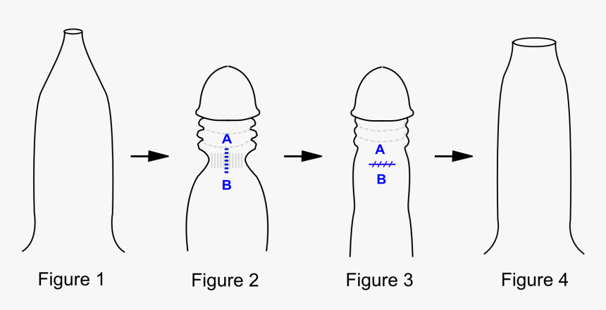 Fimosis Operacion, HD Png Download