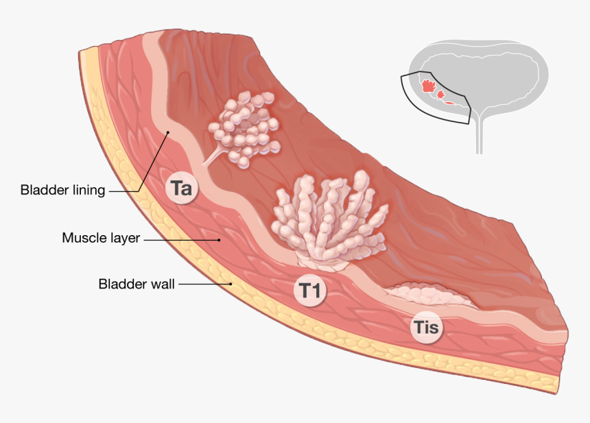 Bladder Cancer Staging, HD Png Download
