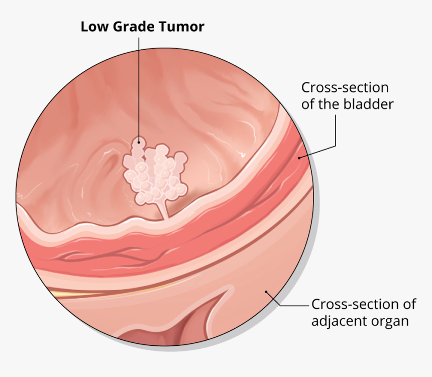 Types Of Bladder Cancer, HD Png Download