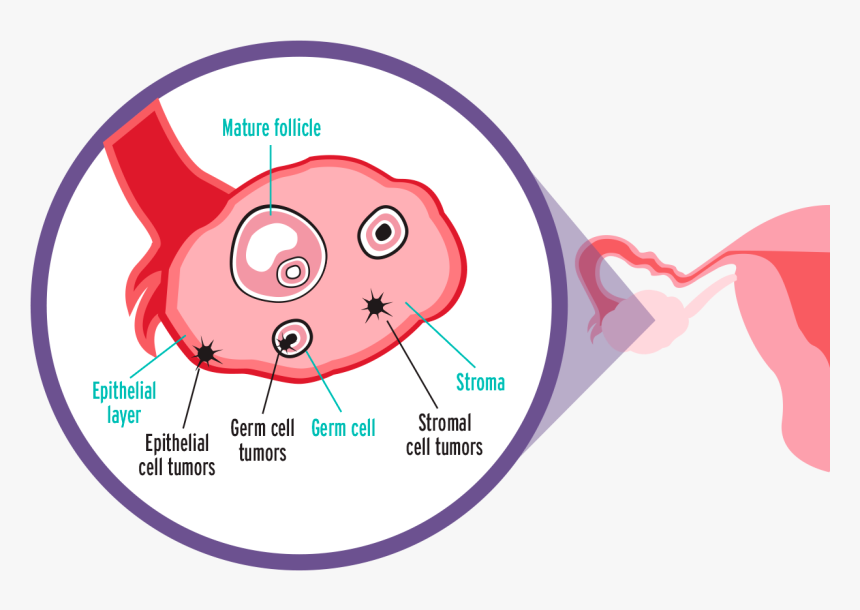Epithelial Ovarian Cancer, HD Png Download