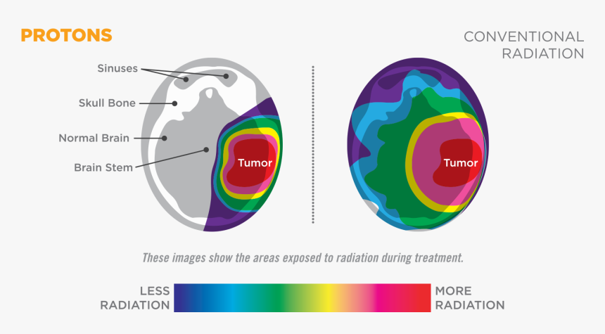 Proton Beam Therapy Diagram, HD Png Download