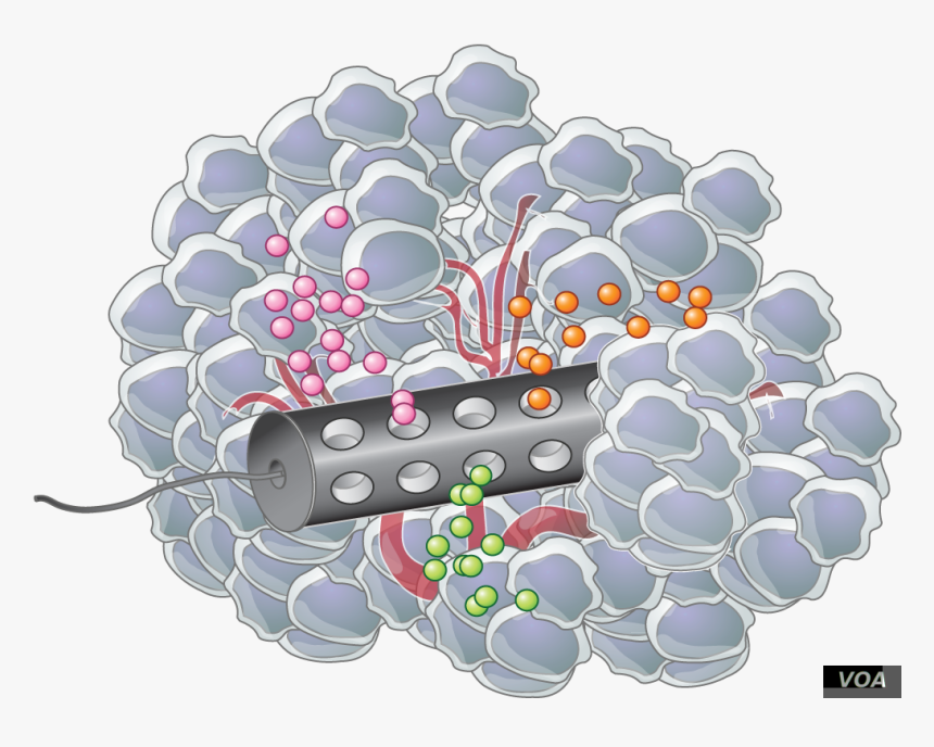 Placed In The Tumor, The Device Releases Microdoses - Implantable Therapeutic Cancer, HD Png Download