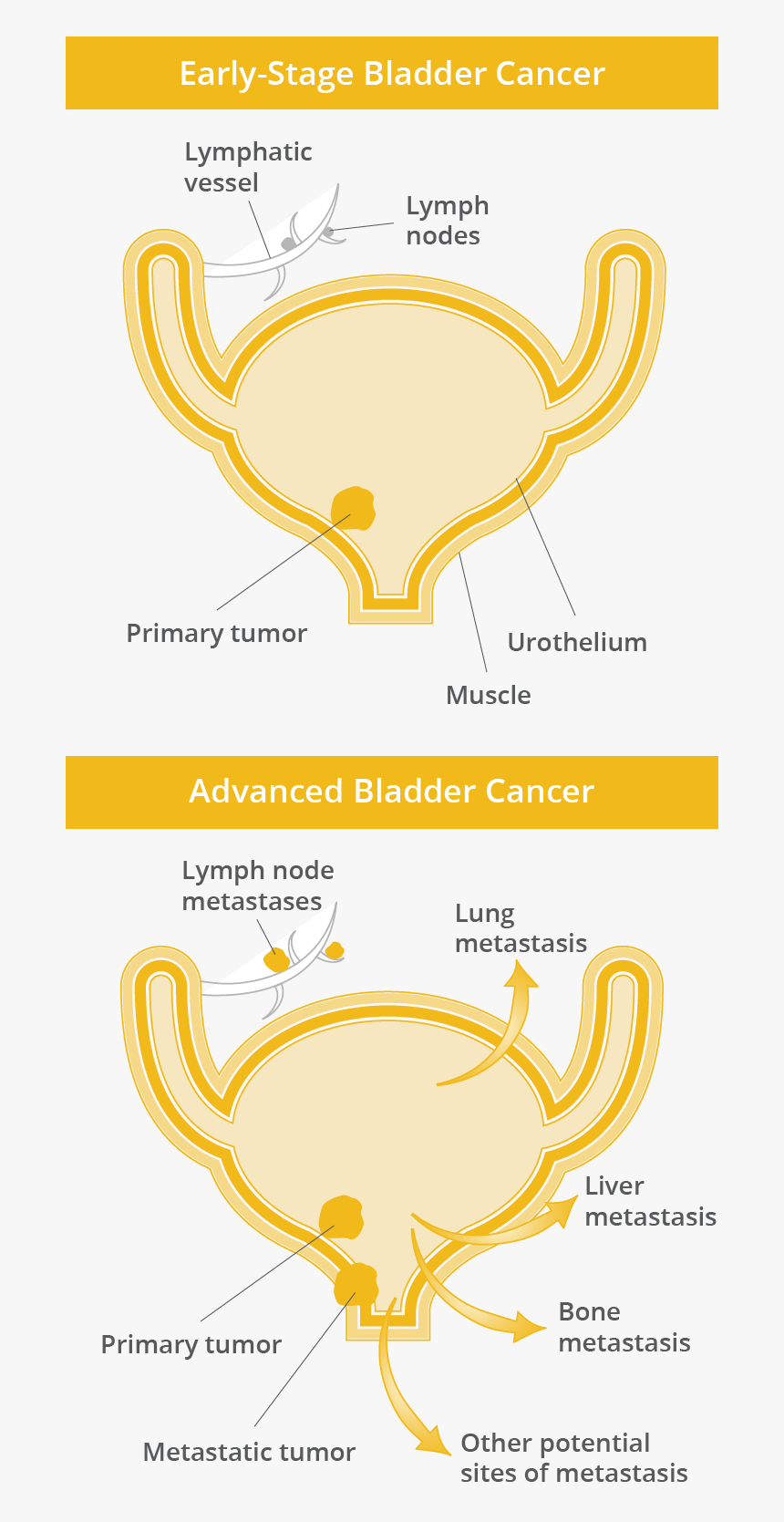 Early Stage Bladder Cancer Showing Little Spread Vs - Illustration, HD Png Download