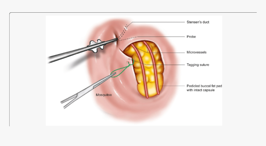 Surgical Procedure For The - Herniation Of Buccal Fat Pad, HD Png Download