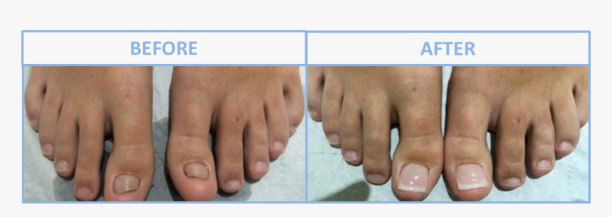 Transparent Fingernail Png - Toe Nail Reconstruction Surgery, Png Download