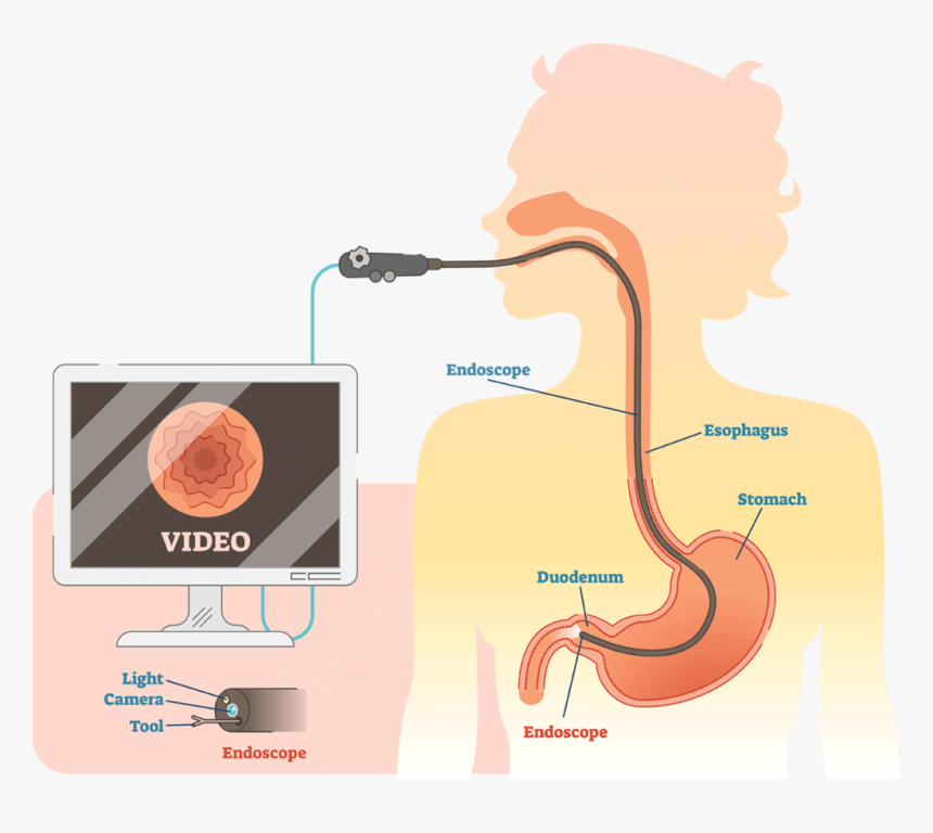 Endoscopic Ultrasound - Inflammation In Esophagus, HD Png Download