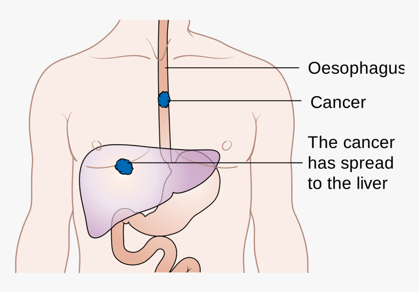 Am Worried About Esophagus Cancer, HD Png Download