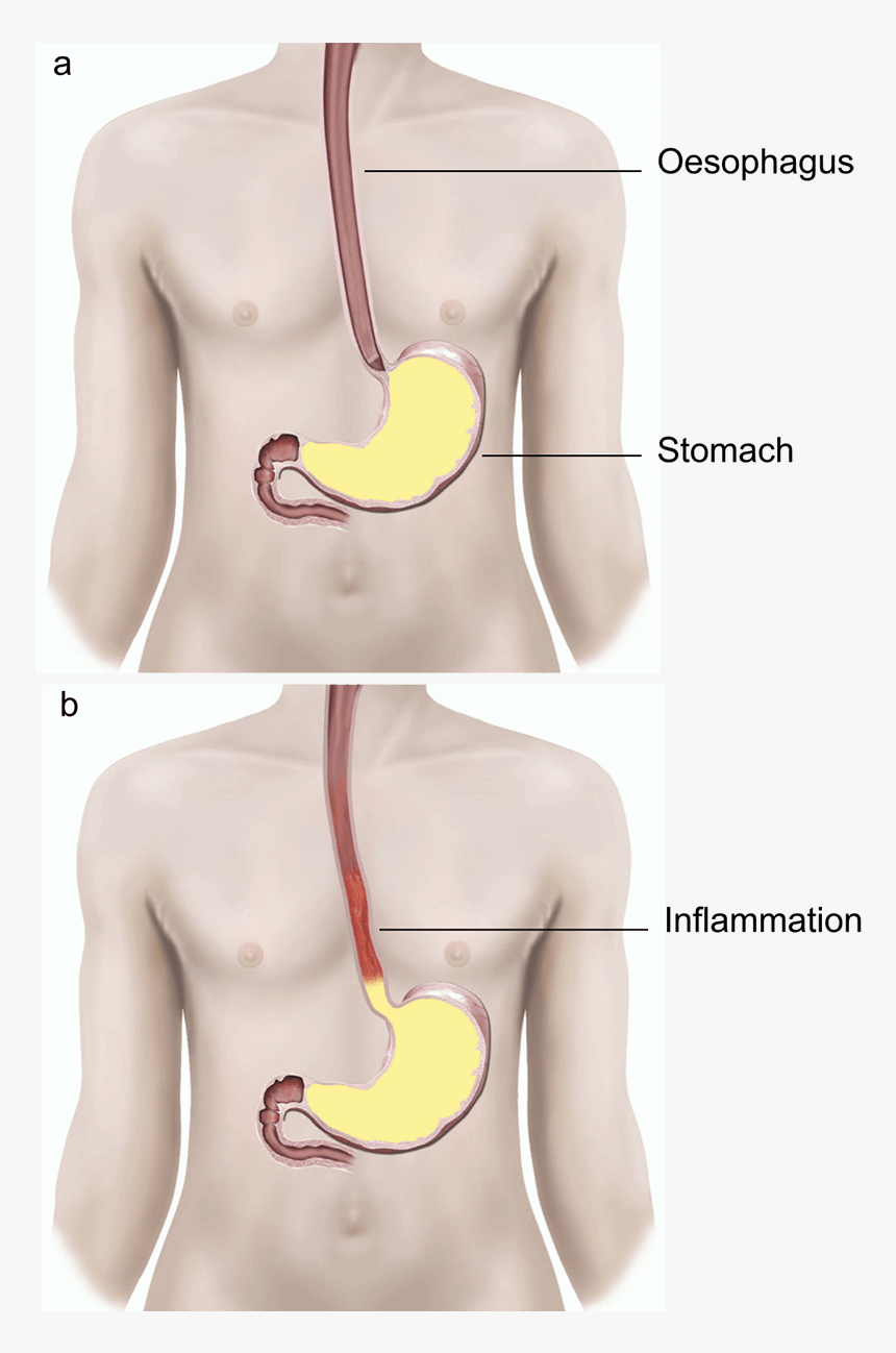 Illustration Showing A Normal Valve And A Faulty Valve - Gerd Surgery Scar, HD Png Download